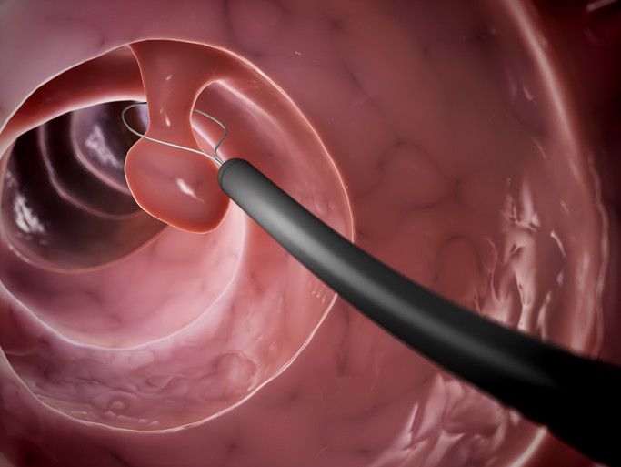 polyectomic surgery